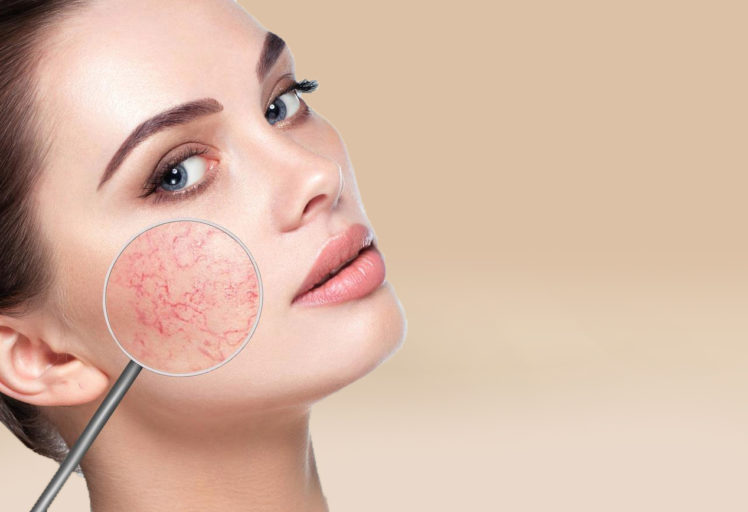 Фототерапия IPL удаление сосудистой сеточки