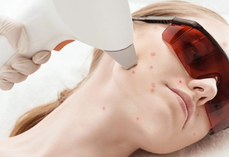 Фототерапия IPL лечение акне