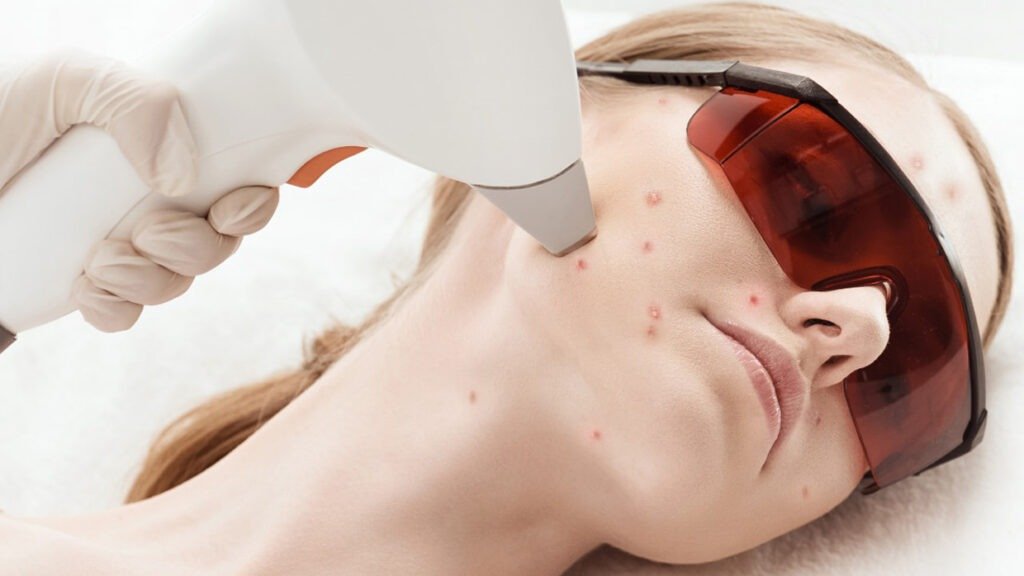 Фототерапия IPL лечение акне