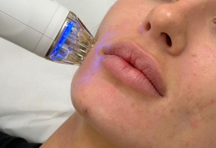 Фракционный микроигольчатый rf